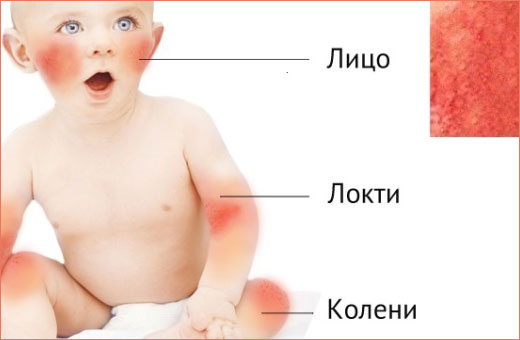 Покраснение вокруг рта у ребенка. Фото, причины и лечение, рацион питания