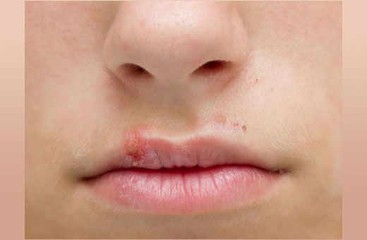 Покраснение вокруг рта у ребенка. Фото, причины и лечение, рацион питания