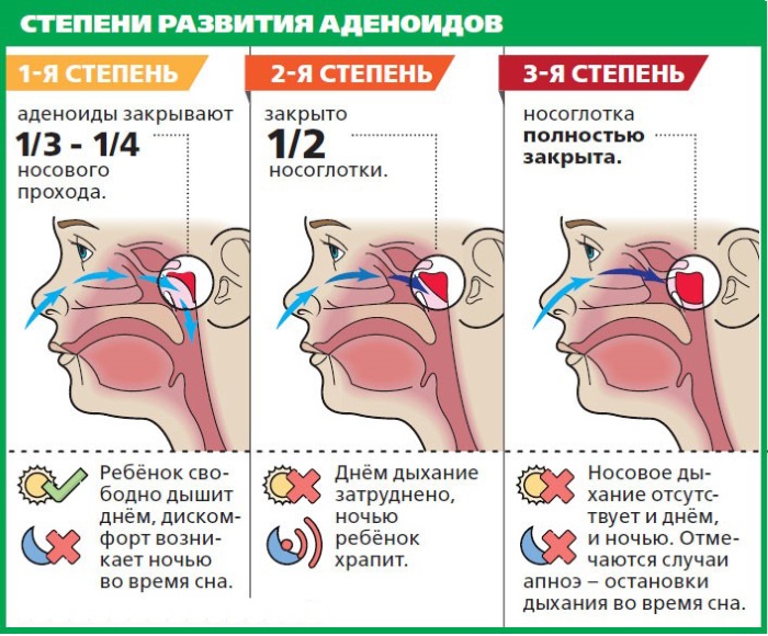 Полидекса или Изофра. Что лучше для ребенка