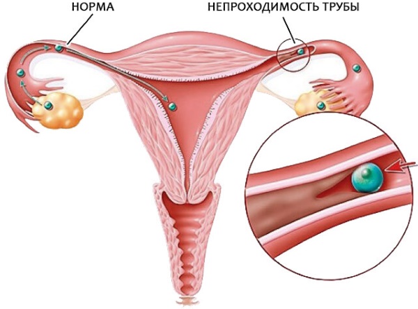 Продувание маточных труб. Как называется процедура, как делают, отзывы