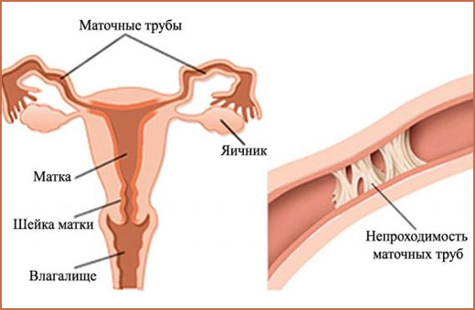 Проходимость маточных труб. Как проверяют, на какой день цикла УЗИ. Как проходит процедура. Восстановление