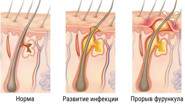 Прыщи после родов на лице, подбородке, щеках, ногах, руках. Как избавиться