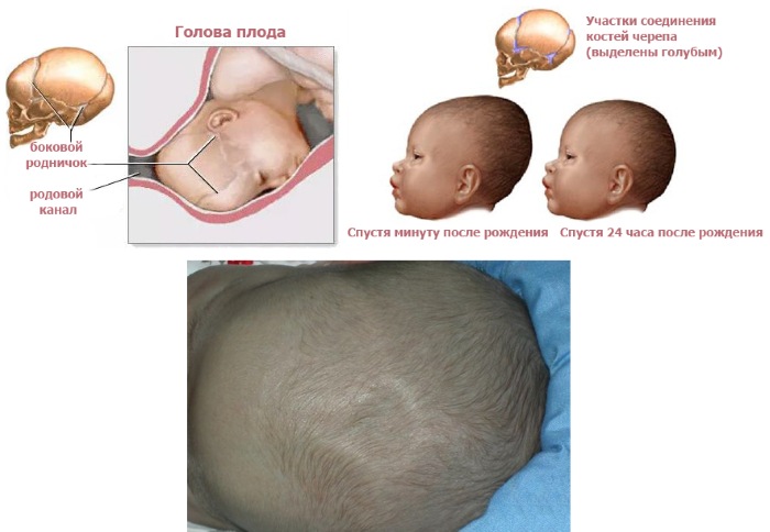 Родничок у новорожденных: когда зарастает - нормы. Где находится, как выглядит, форма. Что означает маленький, большой, если пульсирует