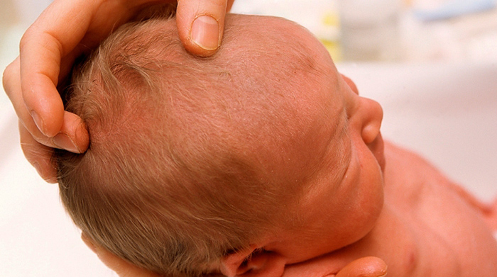 Родничок у ребенка большой, маленький. Когда закрывается, возраст, почему впалый, выпуклый, пульсирует