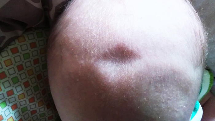 Родничок у ребенка большой, маленький. Когда закрывается, возраст, почему впалый, выпуклый, пульсирует