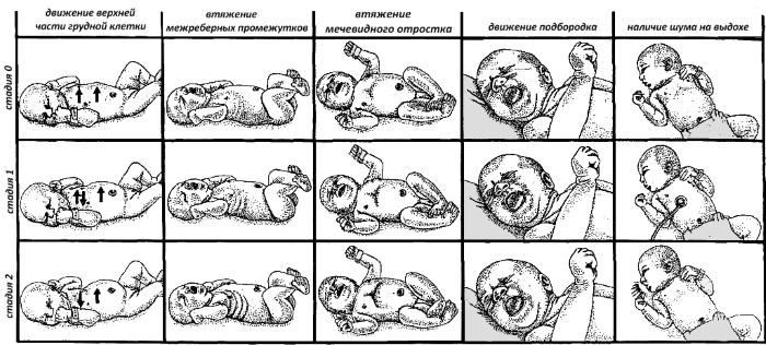 Шкала Сильвермана, Апгар, Даунса для новорожденных. Таблица, оценка состояния, алгоритм диагностики