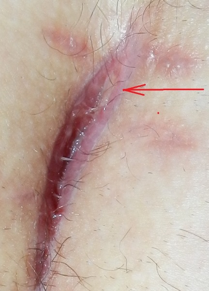 Шов после кесарева сечения: уход, сколько заживает уплотнение, что делать, если болит, разошелся, сочится, мокнет, загноился, покраснел