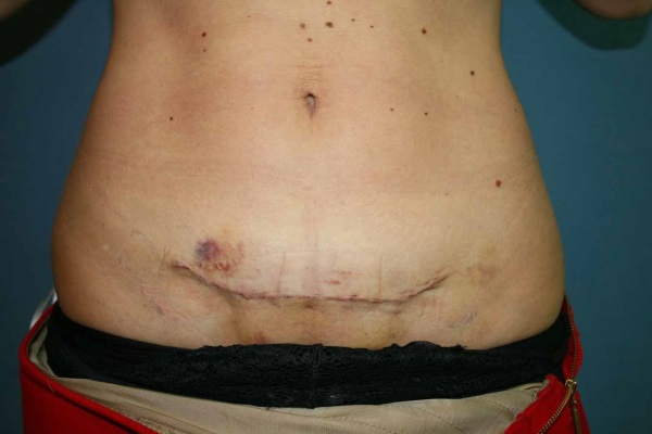 Шов после кесарева сечения: уход, сколько заживает уплотнение, что делать, если болит, разошелся, сочится, мокнет, загноился, покраснел