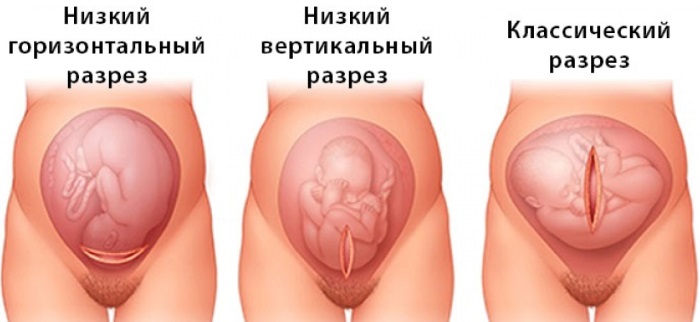 Шов после кесарева сечения: уход, сколько заживает уплотнение, что делать, если болит, разошелся, сочится, мокнет, загноился, покраснел