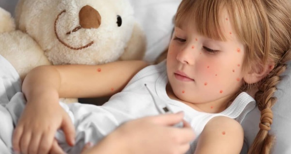 Симптомы краснухи у детей. Фото от начальной стадии до конечной, чем лечить