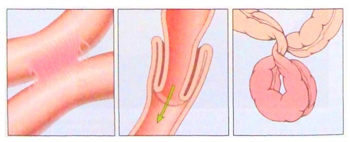 Слизь в кале у новорожденного на грудном, искусственном, смешанном вскармливании. Причины, лечение