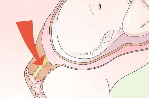 Слизистая пробка перед родами. Фото, как выглядит, за сколько отходит, размеры, какого цвета