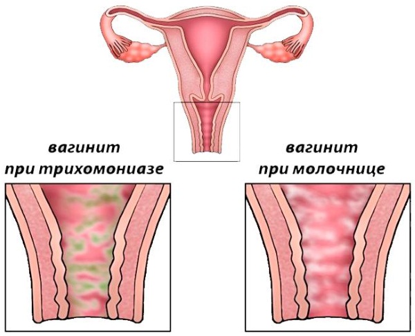 Слизистая пробка перед родами. Фото, как выглядит, за сколько отходит, размеры, какого цвета