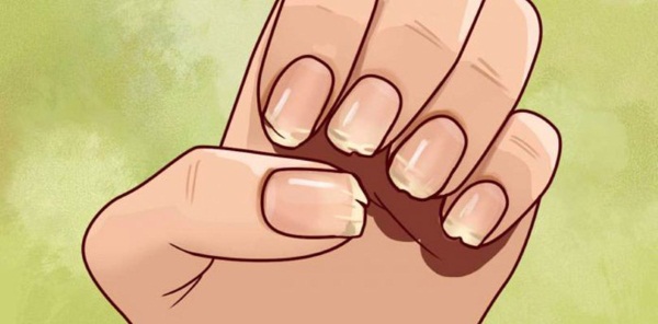 Слоятся ногти на руках у ребенка. Причины и лечение: препараты, народными средствами, витамины, диета