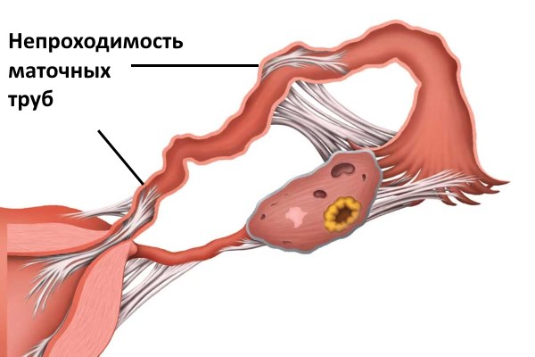 Эко оплодотворение - что это такое, виды, как проходит, где сделать, минусы и возможные последствия