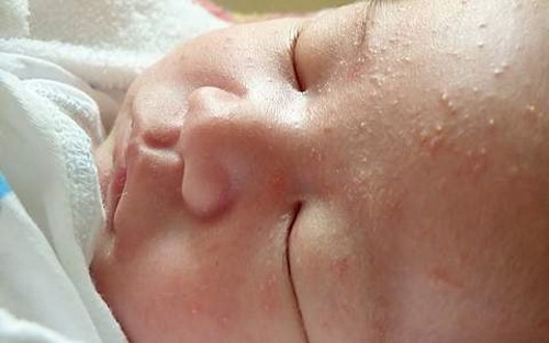 Сыпь на щеках у грудного ребенка. Фото, что это значит, что делать, как лечить