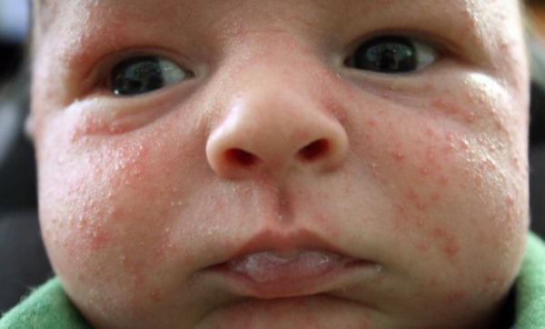 Сыпь на щеках у грудного ребенка. Фото, что это значит, что делать, как лечить