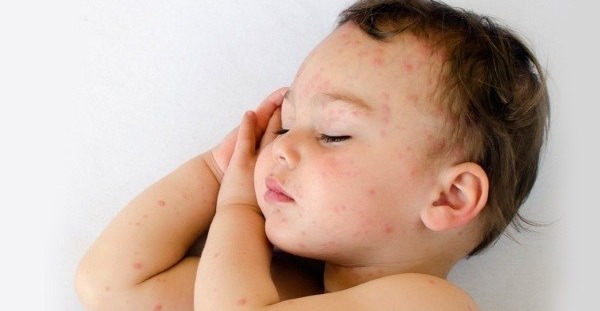 Сыпь по всему телу у ребёнка без температуры и с ней, не чешется, что это, лечение