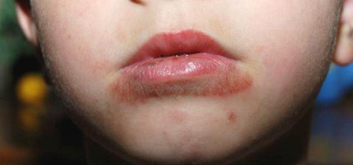 Сыпь вокруг рта у ребенка. Причины 2-3, 5-6 лет, чем лечить, что советует Комаровский