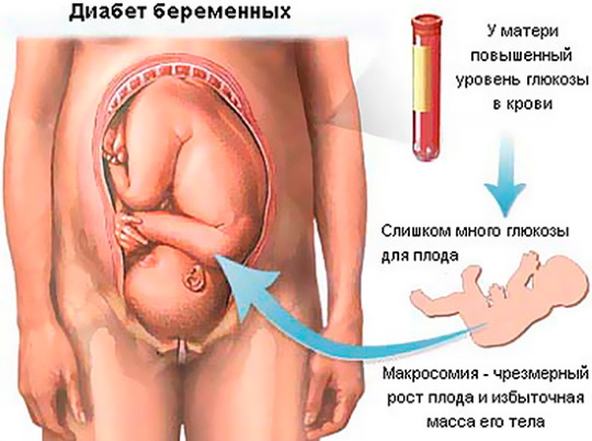 СЗРП при беременности. Что это такое в 30-38 недели, что делать
