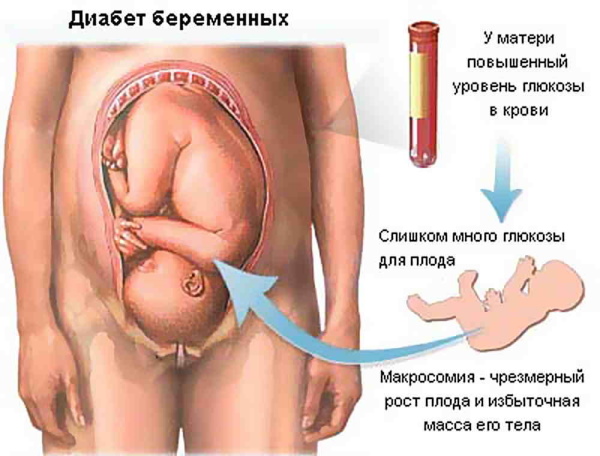 Тошнит от сладкого при беременности на ранних, поздних сроках. Причины