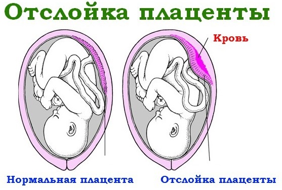 Деформированное плодное яйцо: как выглядит на УЗИ, что значит