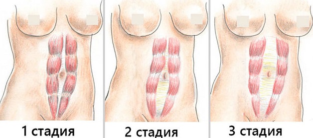 Диастаз после родов - что это, как определить, симптомы, лечение, как устранить, упражнения гимнастики, физиотерапевтические процедуры и операция