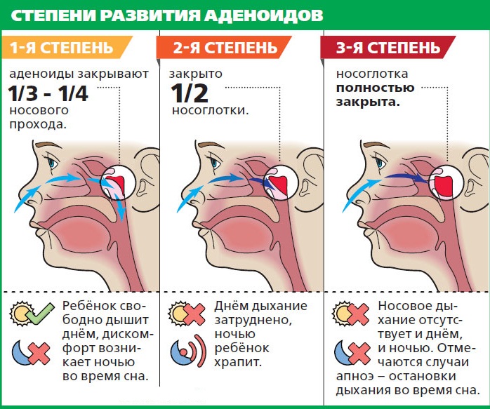 У ребенка заложен нос, но нет соплей. Причины, чем лечить дома