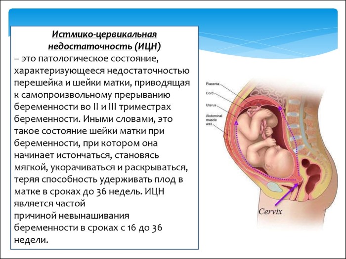 Угроза выкидыша на ранних сроках. Симптомы, причины, лечение по Сунне, народными средствами, лекарства. Как сохранить ребенка