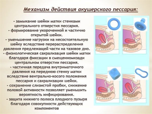 Установка пессария при беременности. Отзывы