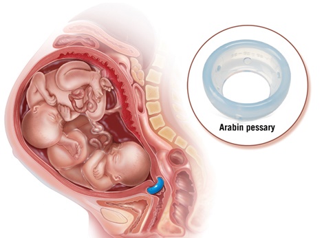 Установка пессария при беременности. Отзывы