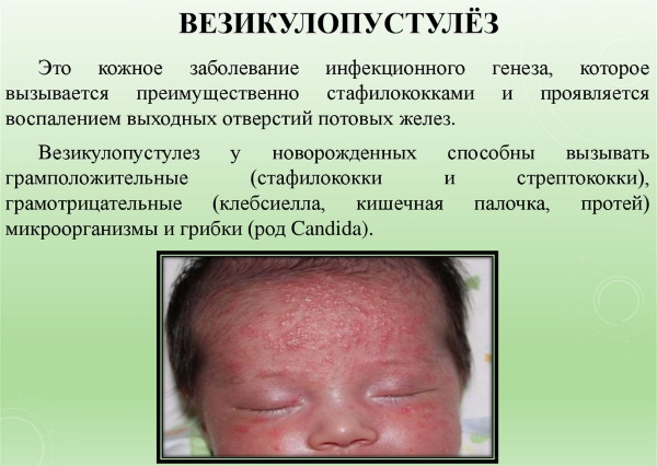 Везикулопустулез у новорожденных детей. Что это такое, причины, лечение, клинические рекомендации