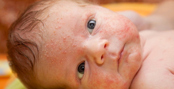 Везикулопустулез у новорожденных детей. Что это такое, причины, лечение, клинические рекомендации