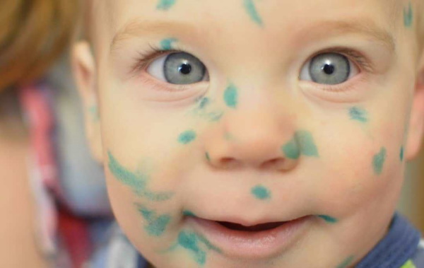 Везикулопустулез у новорожденных детей. Что это такое, причины, лечение, клинические рекомендации