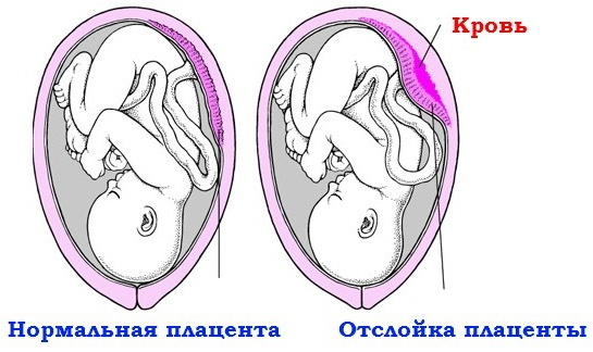 Второе кесарево сечение. Отзывы, на каком сроке делают, как проходит, больнее первого или нет