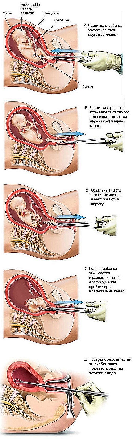 Замершая беременность. Признаки на ранних сроках, во втором триместре, причины, выскабливание, восстановление