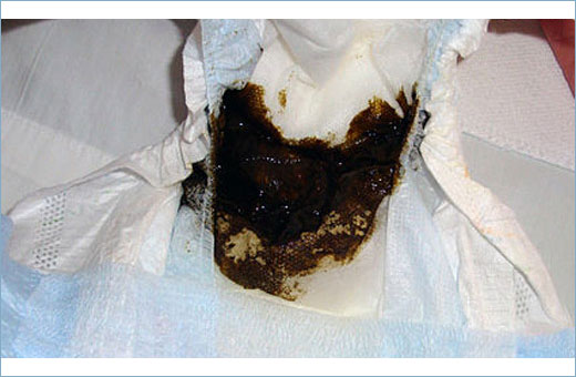 Зеленый стул у грудничка на грудном, искусственном, смешанном вскармливании. Причины и лечение