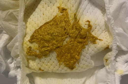 Зеленый стул у грудничка на грудном, искусственном, смешанном вскармливании. Причины и лечение