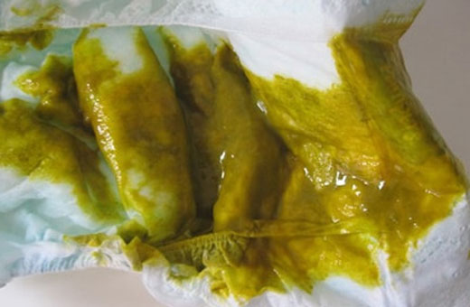 Зеленый стул у грудничка на грудном, искусственном, смешанном вскармливании. Причины и лечение