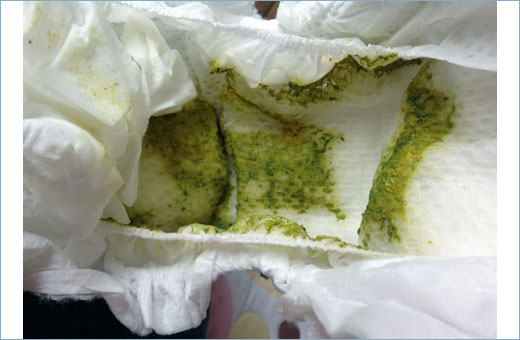 Зеленый стул у грудничка на грудном, искусственном, смешанном вскармливании. Причины и лечение