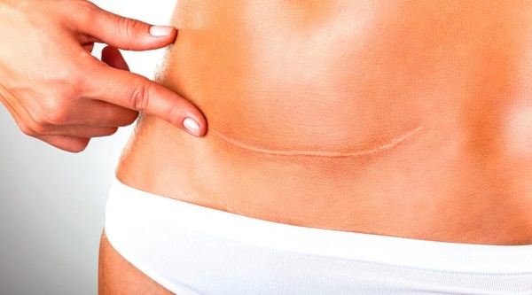 Как убрать живот после кесарева. Восстановление, спорт, питание, обертывание, массаж