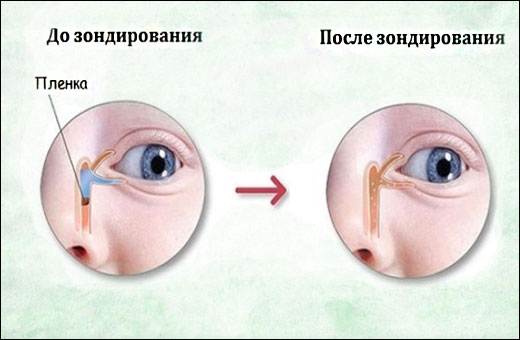 Зондирование слезного канала у новорожденных. Что это, как проводится, последствия операции